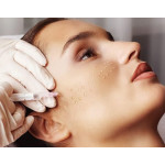 Мезотерапия